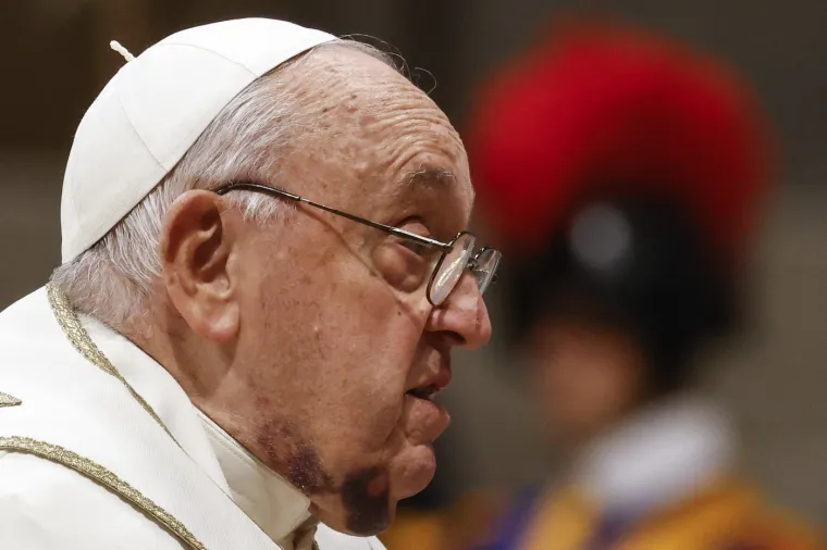 Pao dok je ustajao iz kreveta? Papa Franjo vodio misu za kardinale s licem punim modrica