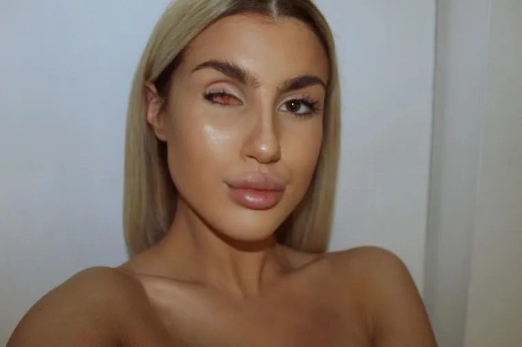 Nakon što je izgubila oko zbog raka, ova dvojnica Kim Kardashian, kako joj mnogi tepaju, počela je objavljivati svoje fotografije kojima želi pokazati kako i žene s tjelesnim nedostacima mogu biti lijepe.