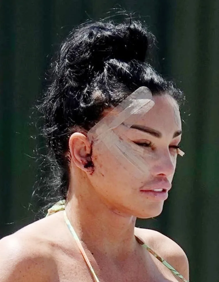 Britanska reality zvijezda Katie Price šokirala nakon operacije lica