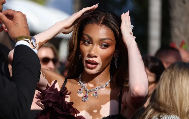 Ovo je Winnie Harlow - manekenka koja boluje od iste bolesti kao Michael Jackson