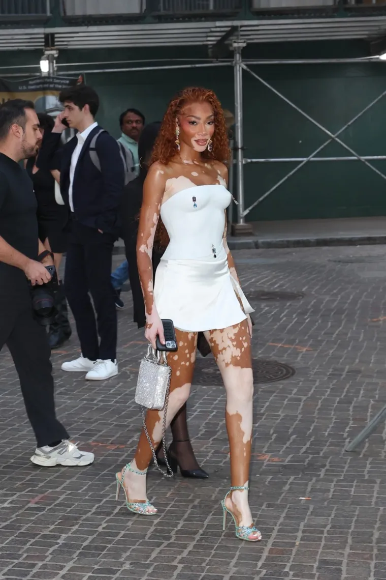 Ovo je Winnie Harlow - manekenka koja boluje od iste bolesti kao Michael Jackson
