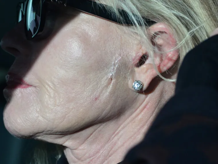 Melanie Griffith šminkom prekrila novi ožiljak na licu: Crne rukavice potaknule nova nagađanja o zdravstvenim problemima
