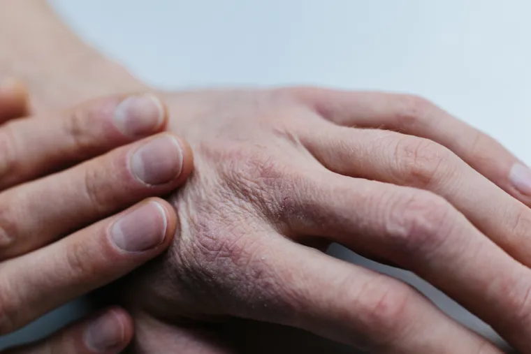 7. Liječenje kožnih problema: Kopriva ima prirodna adstrigentna svojstva, a adstrigenti su izvrsni za liječenje problema s kožom kao što su masna koža, suha, svrbežna i upaljena koža uzrokovana ubodima insekata, vodene kozice pa čak i ekcem.
