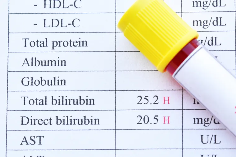 12. Bilirubin je pigment, razgradni produkt hema – sastavnog dijela hemoglobina. Povišene vrijednosti u krvi (hiperbilirubinemija) vidi se u bolestima pojačanog stvaranja ili nedostatnog izlučivanja bilirubina u krvi. Bolesnici s povišenim bilirubinom imaju žućkastu boju bjeloočnica i kože. Povišene vrijednosti govore da se radi o pojačanom raspadu eritrocita, dakle o hemolizi odnosno hemolitičkoj anemiji ili pak bolesti jetre (oštećenje stanica jetre i/ ili žučnih puteva) koja je posljedica upale jetre (hepatitisa), ciroze ili zloćudne bolesti jetre. Žučni kamenci mogu začepiti izvodne kanale žući u crijevo pa zato bilirubin ulazi u krvnu cirkulaciju i uzrokuje hiperbilirubinemiju. Poremećaji stvaranja i izlučivanja bilirubina mogu biti nasljedni.