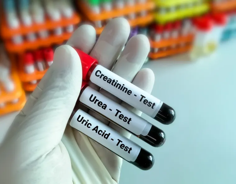 14. Kreatinin je metabolički produkt koji se izlučuje putem bubrega. Količina stvaranja kreatinina ovisi o mišićnoj masi – ljudi s manjom mišićnom masom imaju imaju niže vrijednosti kreatinina. Povišene vrijednosti kreatinina ukazuju na funkciju bubrega, kod zatajivanja funkcije bubrega dolazi do porasta koncentracije kreatinina u krvi.