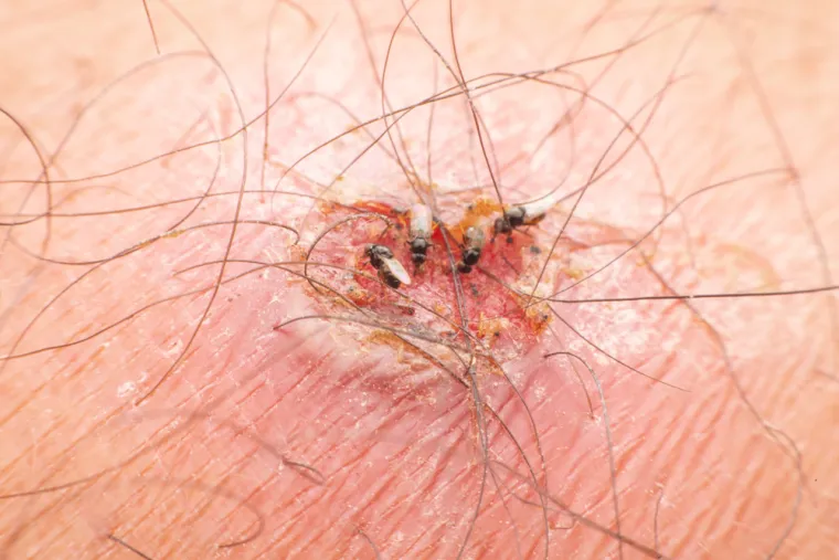6. Dermatobia hominis poznata je još i kao &quot;ljudska muha&quot;, torsalo ili američka muha pevka, a njene ličinke napadaju ljude kao parazit. Porijeklom je iz Srednje i Južne Amerike, a lijepe svoja jaja na komarce i druge insekte koji sišu krv. Kada ugrize žrtvu, izleže jaja kremaste boje i ličinke se probijaju u kožu domaćina. Mogu prodrijeti do pet centimetara u ljudsko meso prije nego što se nahrane mišićima. &quot;Tada se stvaraju bolni prištići iz kojih curi gnoj, a kojima se male mušice hrane sljedećih pet do deset tjedana&quot;, rekao je profesor Hart.