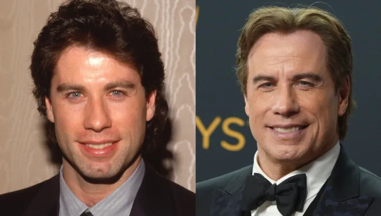 Glumac koji je zasigurno zapeo u ralje plastičnih operacija je John Travolta (68). Navodno redovito ide na injekcije botoksa, zatezanje lica te je imao i transplantaciju kose, piše portal Celebshistory. &quot;Može se vidjeti da je zatezao kapke i napravio facelifting. Ako ništa drugo, možda je išao na ubrizgavanje botoksa i filera kako bi održao malo mlađi izgled i maknuo male bore i nabore na licu. Obrve su mu tamnije, a možda i obojene, po potrebi za ulogu&quot;, rekao Dr. Andrew Miller za Glamourfame.