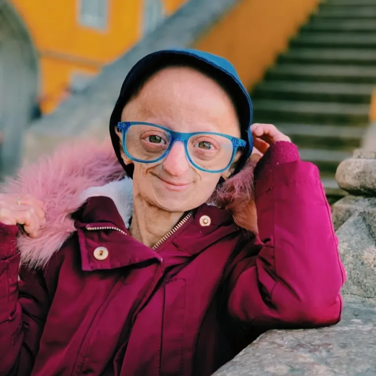 CLAUDIA STARI SEDAM PUTA BRŽE: Ima tek 20 godina, a zbog bolesti izgleda poput starice