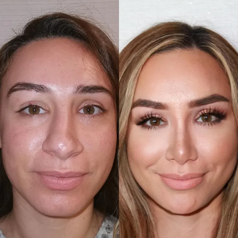 Turska klinika hvali se na Instagramu nevjerojatnim transformacijama pacijenata