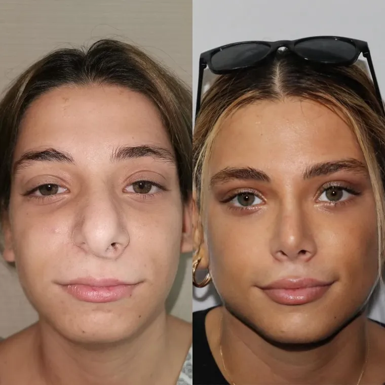 Turska klinika hvali se na Instagramu nevjerojatnim transformacijama pacijenata
