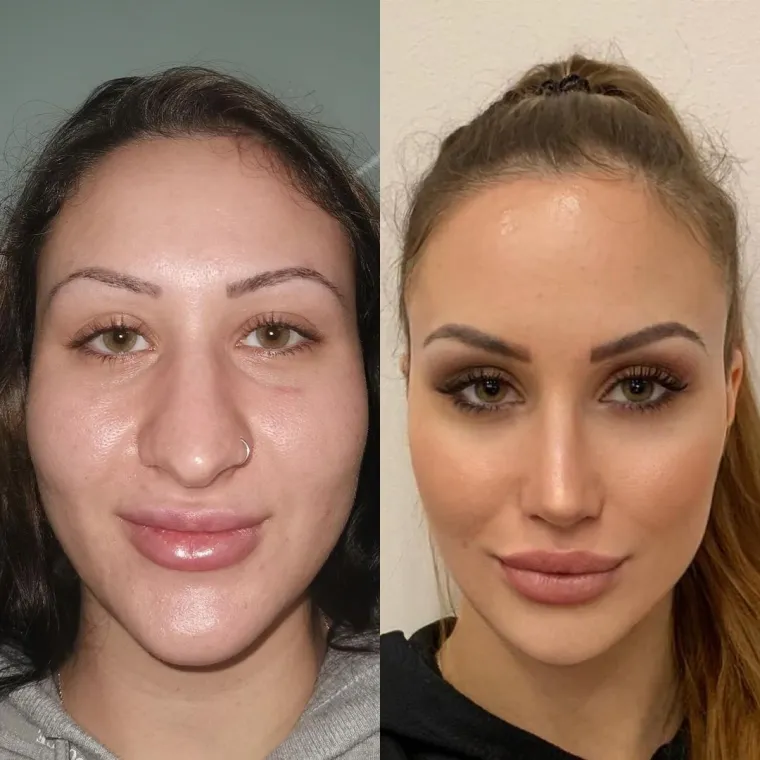 Turska klinika hvali se na Instagramu nevjerojatnim transformacijama pacijenata
