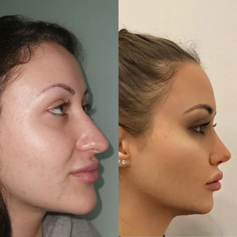 Turska klinika hvali se na Instagramu nevjerojatnim transformacijama pacijenata