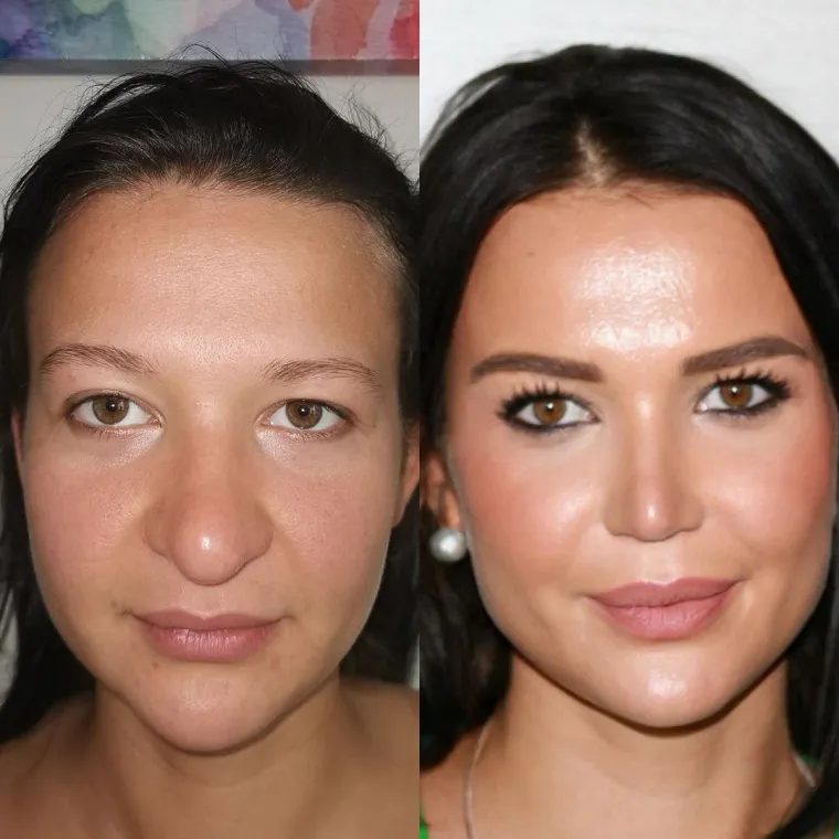 Turska klinika hvali se na Instagramu nevjerojatnim transformacijama pacijenata