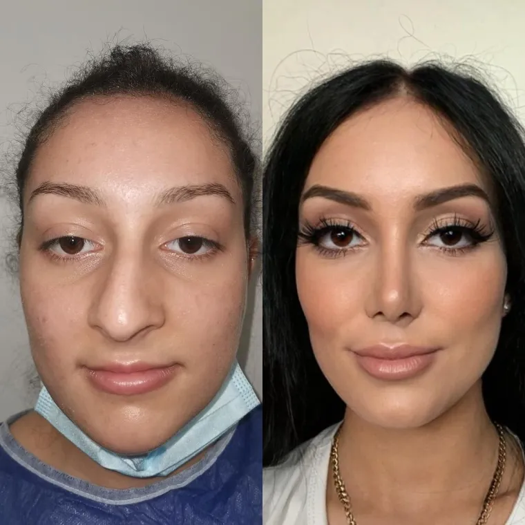 Turska klinika hvali se na Instagramu nevjerojatnim transformacijama pacijenata