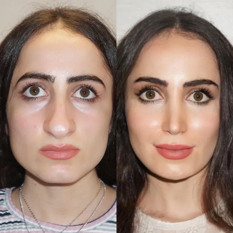 Turska klinika hvali se na Instagramu nevjerojatnim transformacijama pacijenata