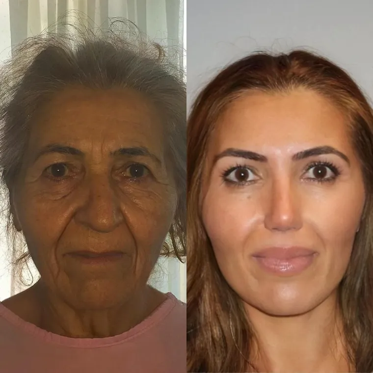 Turska klinika hvali se na Instagramu nevjerojatnim transformacijama pacijenata