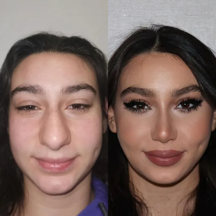 Turska klinika hvali se na Instagramu nevjerojatnim transformacijama pacijenata