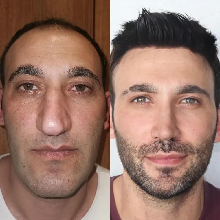 Turska klinika hvali se na Instagramu nevjerojatnim transformacijama pacijenata