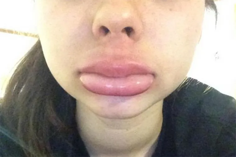 Izazovi iz Amerike nisu toliko maštoviti. Kada su savršeno napućene usne Kylie Jenner zavladale Instagramom, mnoge su je cure pokušale oponašati s uznemirujućim rezultatima.