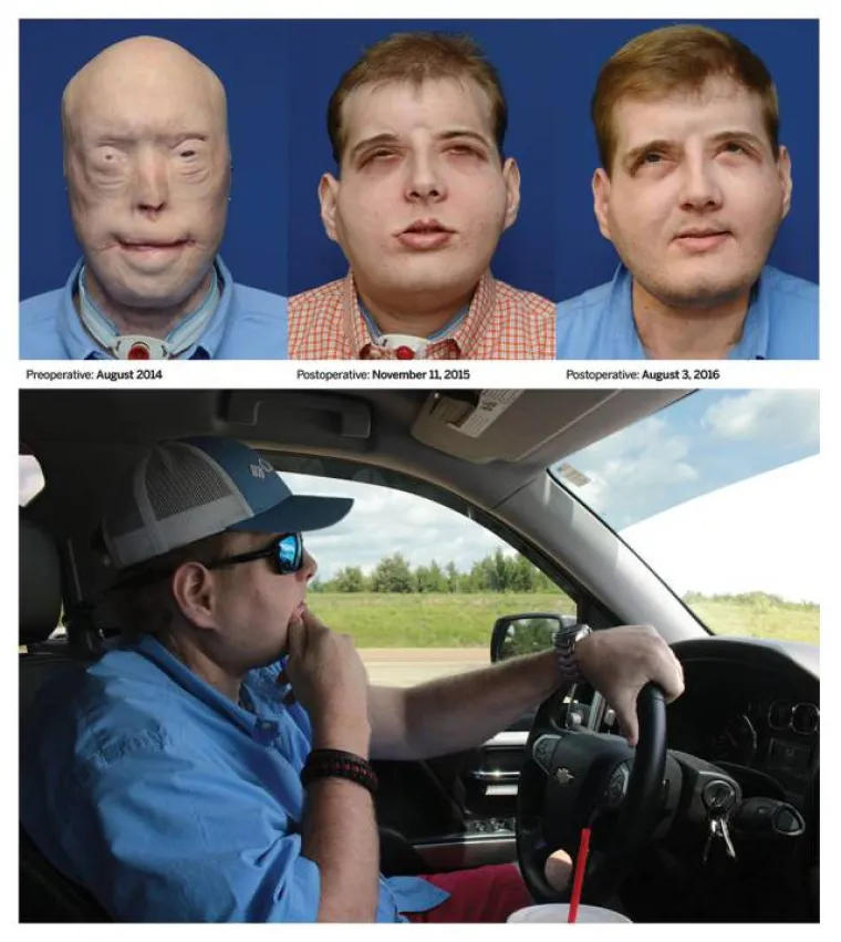 Transplantacija lica je stvarna.