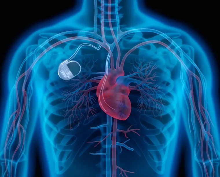 2. Pacemaker: Ovaj uređaj koji spašava živote prvotno je zamišljen kao aparat za slušanje zvukova srca. Izumitelj Wilson Greatbatch slučajno je ugradio pogrešan elektronički dio u prototip, zbog čega je uređaj umjesto zvukova počeo proizvoditi električne impulse slične onima koje stvara srce. Taj neočekivani rezultat doveo je do razvoja prvog srčanog stimulatora, poznatog kao pacemaker.