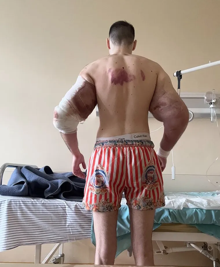 Htio je imati ruke kao bazuke, ali se zaigrao s vazelinom i stavio liječnike na goleme muke