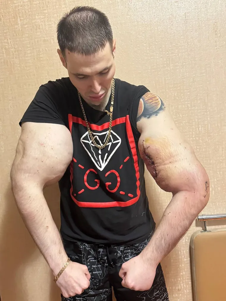 Htio je imati ruke kao bazuke, ali se zaigrao s vazelinom i stavio liječnike na goleme muke