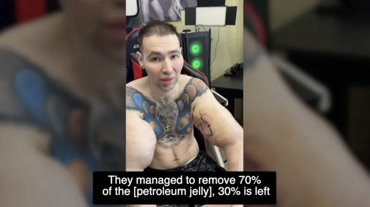 Htio je imati ruke kao bazuke, ali se zaigrao s vazelinom i stavio liječnike na goleme muke