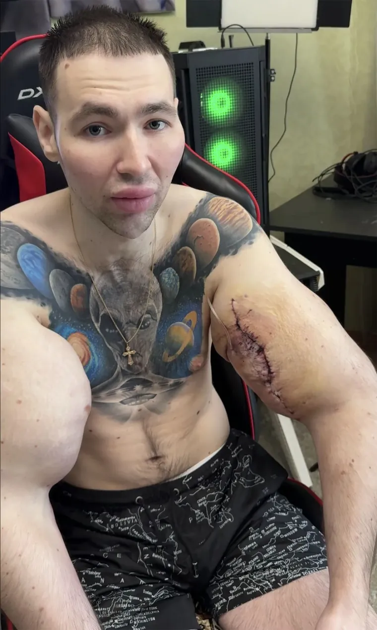 Htio je imati ruke kao bazuke, ali se zaigrao s vazelinom i stavio liječnike na goleme muke