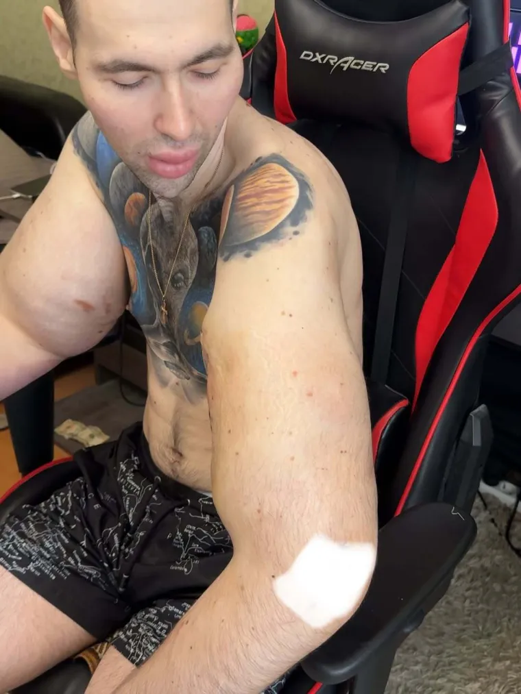 Htio je imati ruke kao bazuke, ali se zaigrao s vazelinom i stavio liječnike na goleme muke