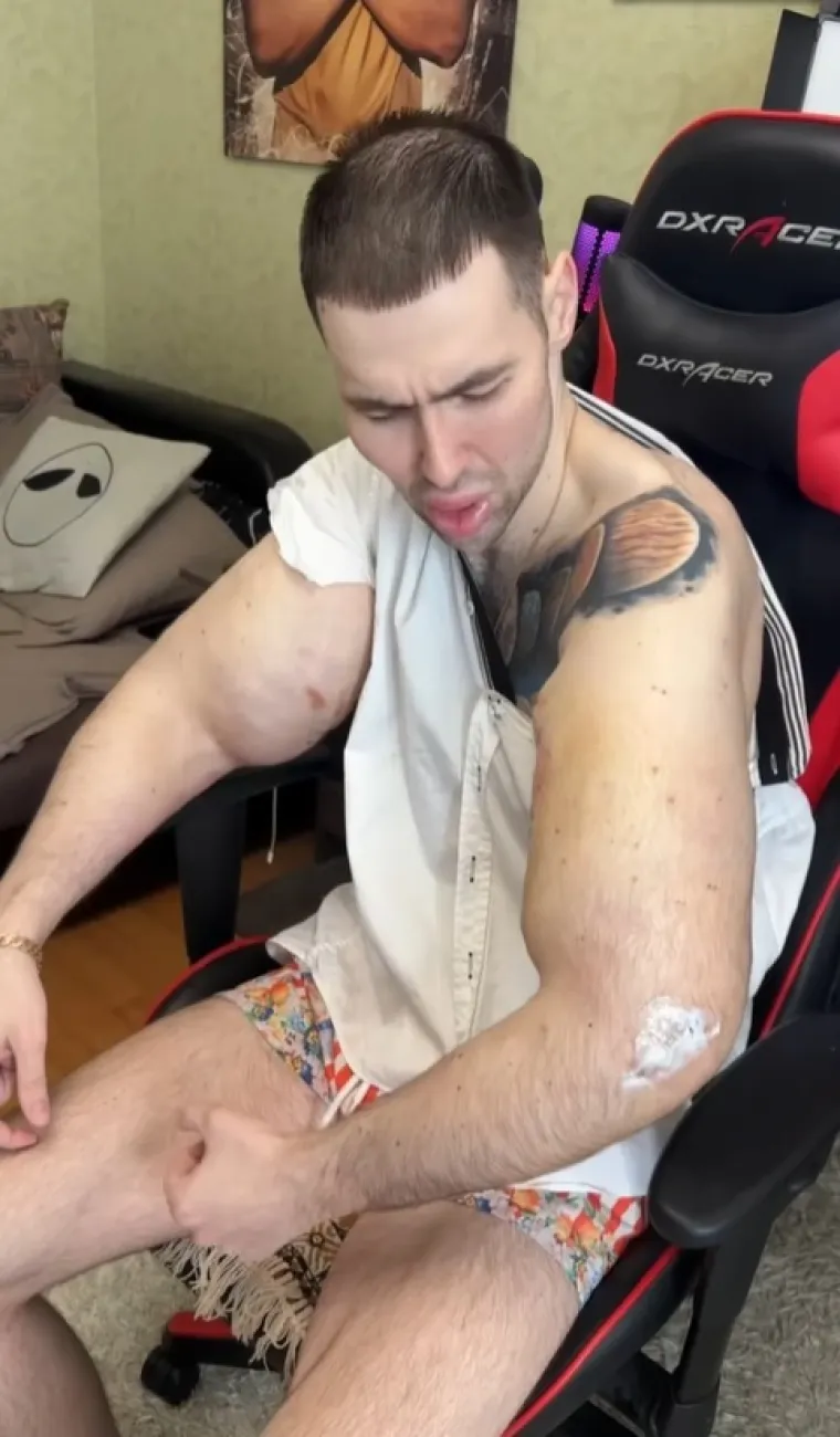 Htio je imati ruke kao bazuke, ali se zaigrao s vazelinom i stavio liječnike na goleme muke