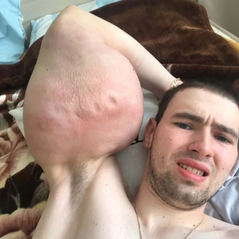 Htio je imati ruke kao bazuke, ali se zaigrao s vazelinom i stavio liječnike na goleme muke