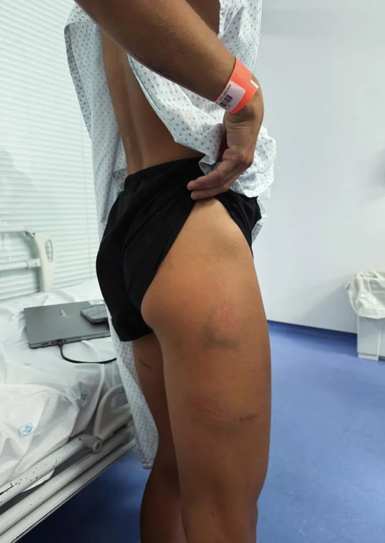 Atletičarka pokazala kako izgleda nakon borbe za život protiv pobješnjele krave: 'Bila sam sigurna da će me ubiti'