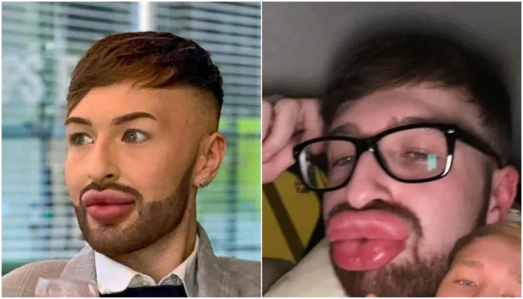 Ovisnost o fileru i botoksu pretvorila ga u patku, a onda je napravio čudo: Sada izgleda kao maneken