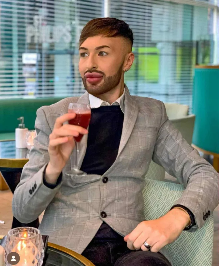 Ovisnost o fileru i botoksu pretvorila ga u patku, a onda je napravio čudo: Sada izgleda kao maneken