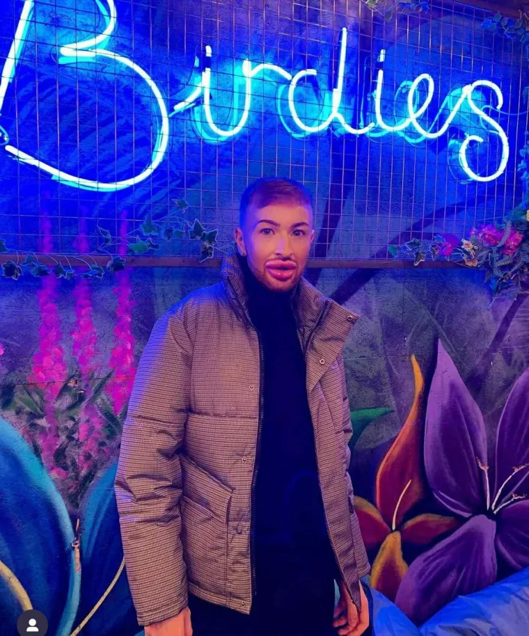 Ovisnost o fileru i botoksu pretvorila ga u patku, a onda je napravio čudo: Sada izgleda kao maneken