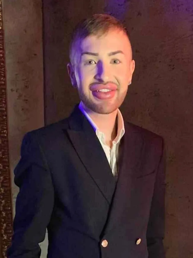 Ovisnost o fileru i botoksu pretvorila ga u patku, a onda je napravio čudo: Sada izgleda kao maneken