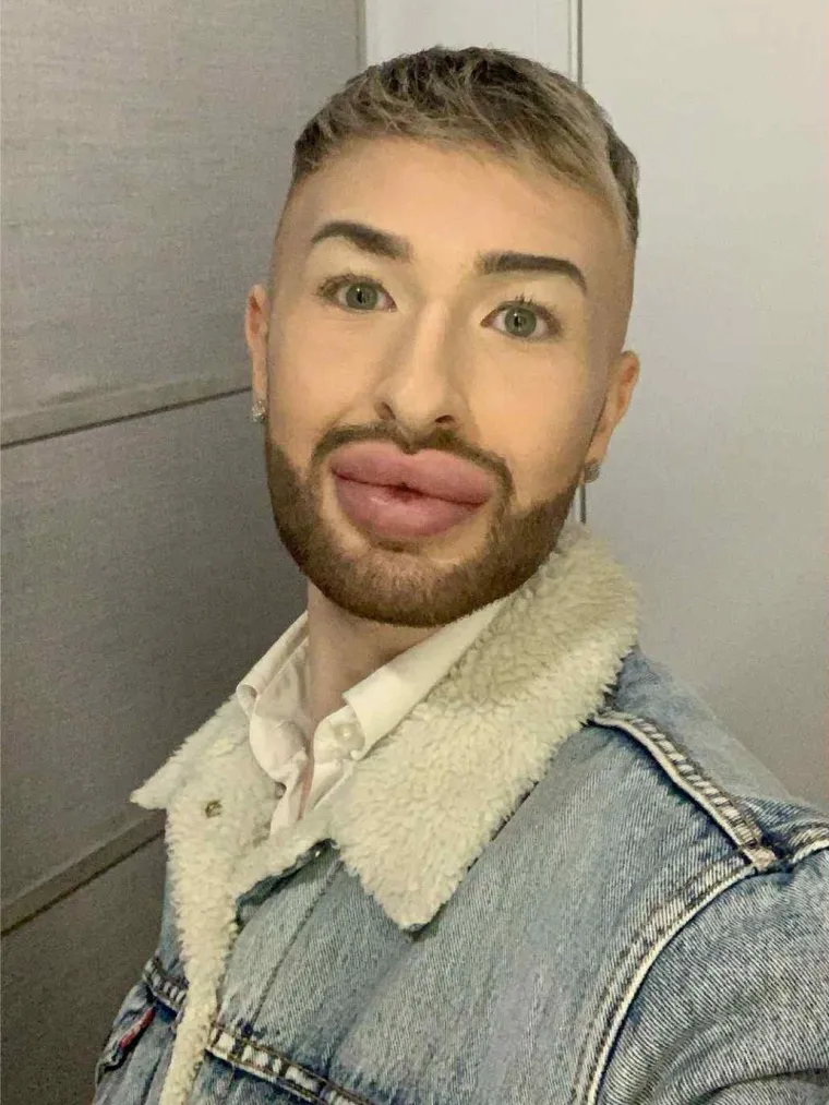 Ovisnost o fileru i botoksu pretvorila ga u patku, a onda je napravio čudo: Sada izgleda kao maneken