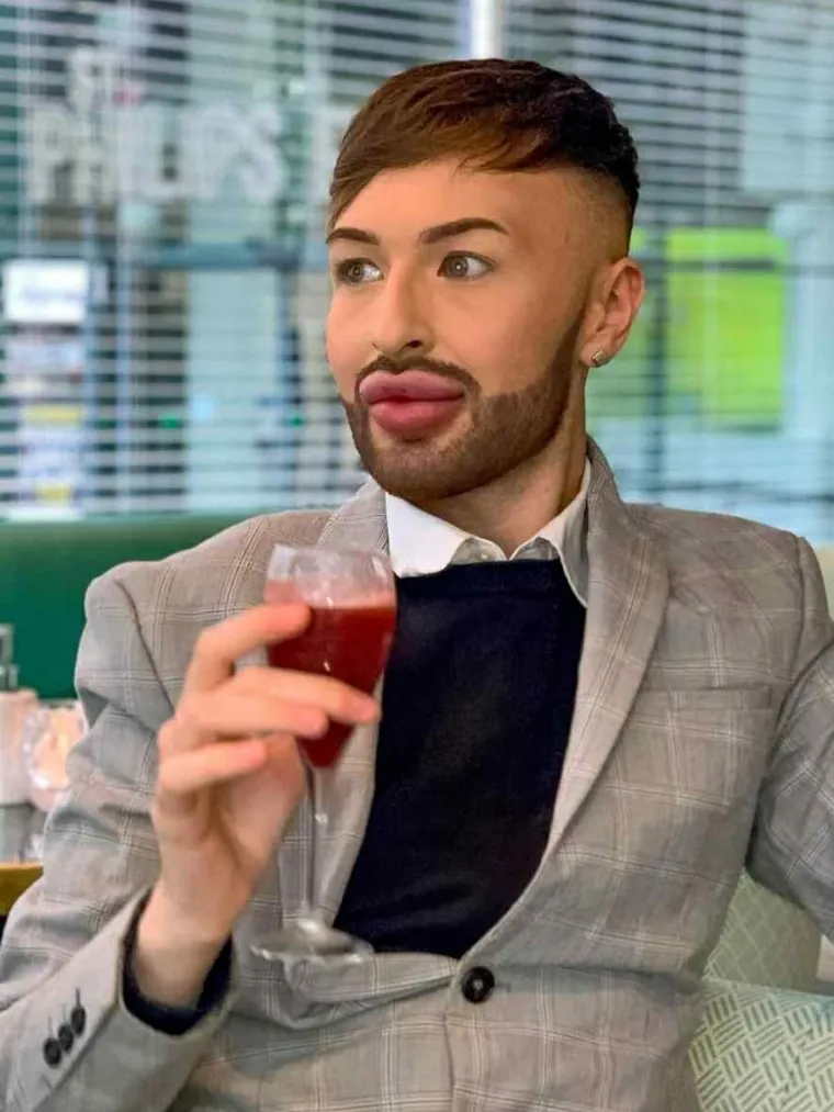 Ovisnost o fileru i botoksu pretvorila ga u patku, a onda je napravio čudo: Sada izgleda kao maneken