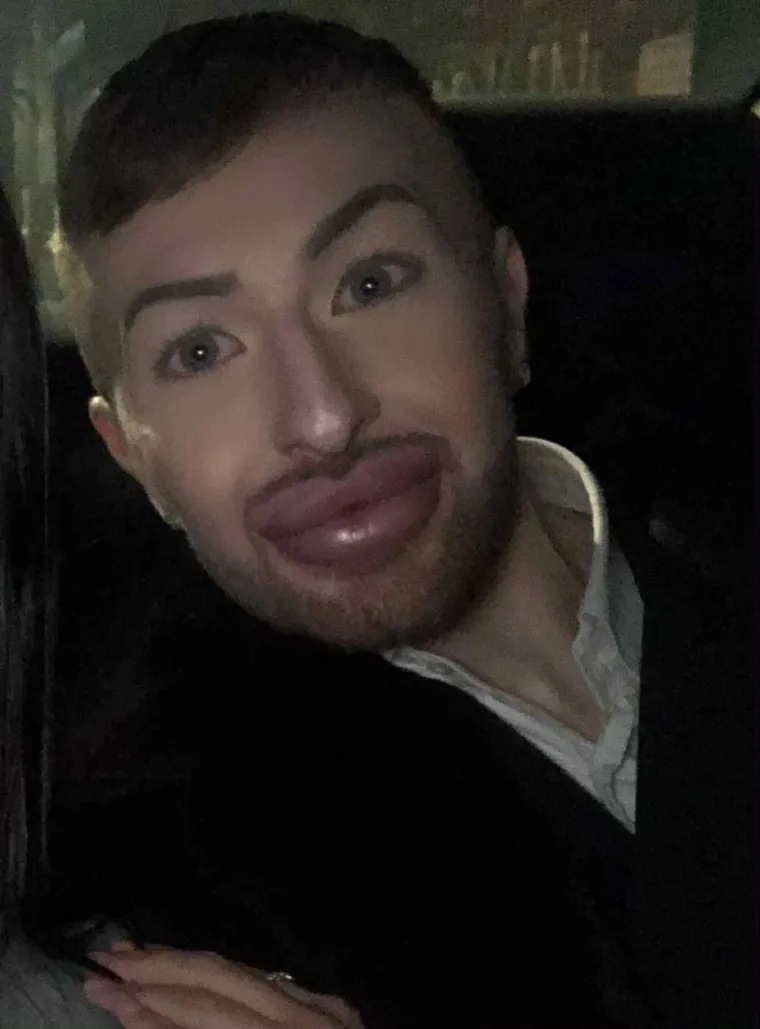 Ovisnost o fileru i botoksu pretvorila ga u patku, a onda je napravio čudo: Sada izgleda kao maneken