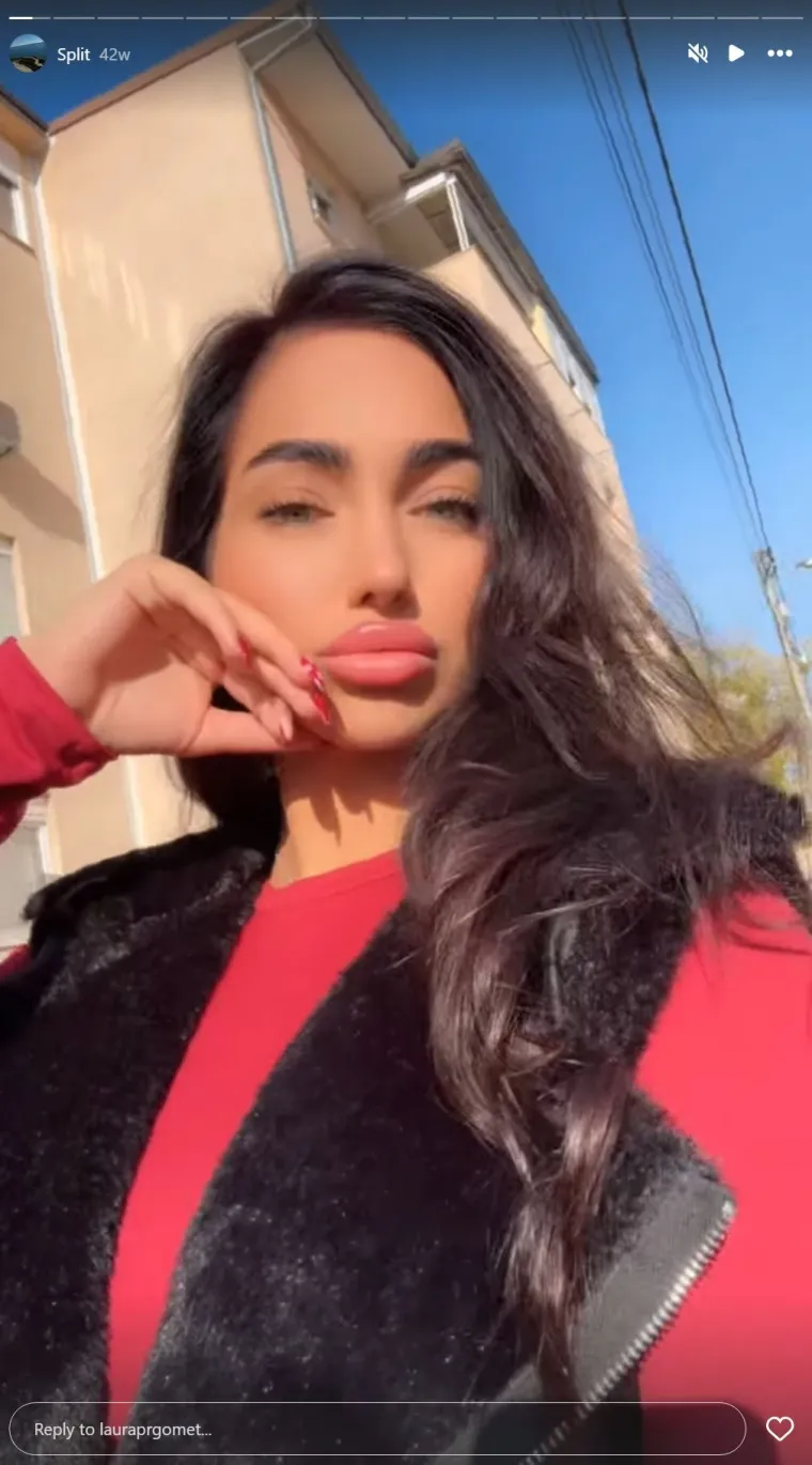 Bila na operaciji grudi i nosa pa opet stavila filere u usne: Laura obožava estetske korekcije