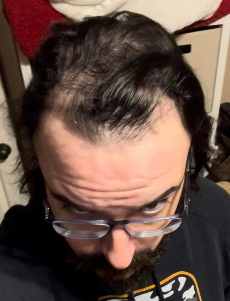 Ćelavite? Postoji divno mjesto na internetu gdje će vam tisuće ljudi pružiti podr&scaron;ku i utjehu