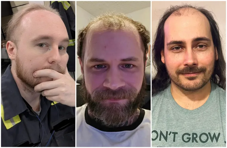 Ćelavite? Postoji divno mjesto na internetu gdje će vam tisuće ljudi pružiti podr&scaron;ku i utjehu