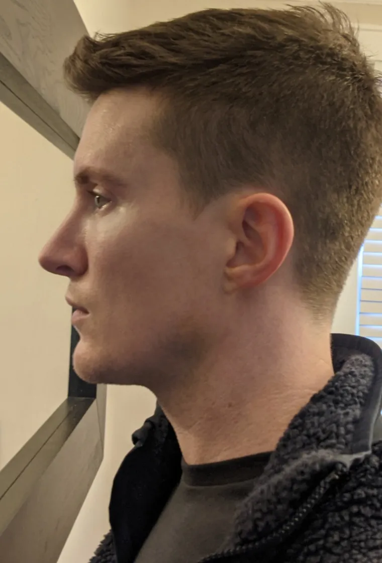 Podvrgnuli se estetskim zahvatima, pa od sebe napravili čudo: Neki su danas neprepoznatljivi