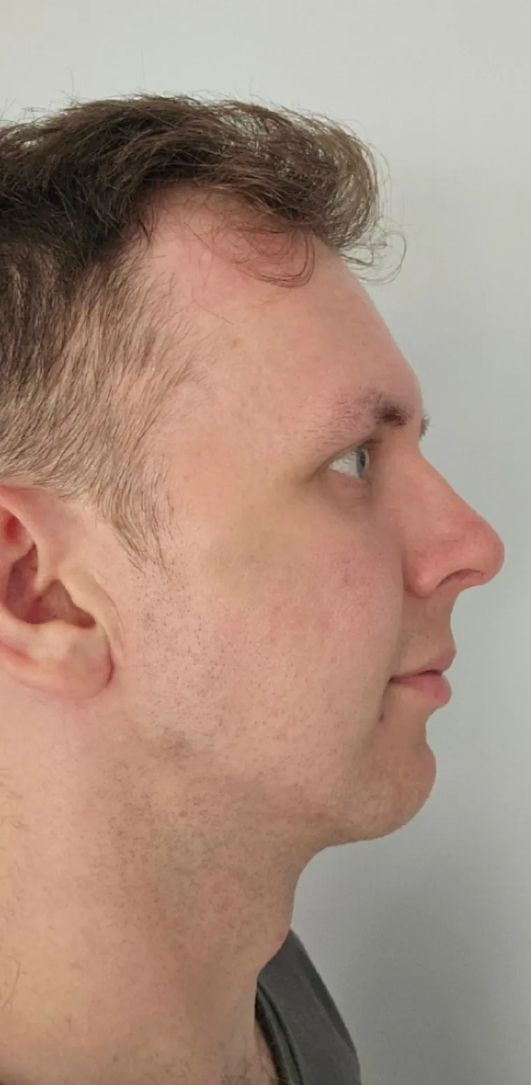 Podvrgnuli se estetskim zahvatima, pa od sebe napravili čudo: Neki su danas neprepoznatljivi