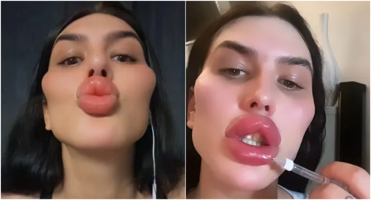 Godinama je punila obraze filerima, a sada je odlučila vratiti prirodno lice: Promjena je ogromna