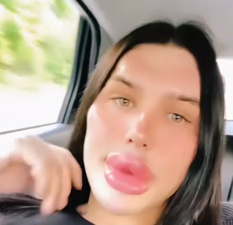 Godinama je punila obraze filerima, a sada je odlučila vratiti prirodno lice: Promjena je ogromna