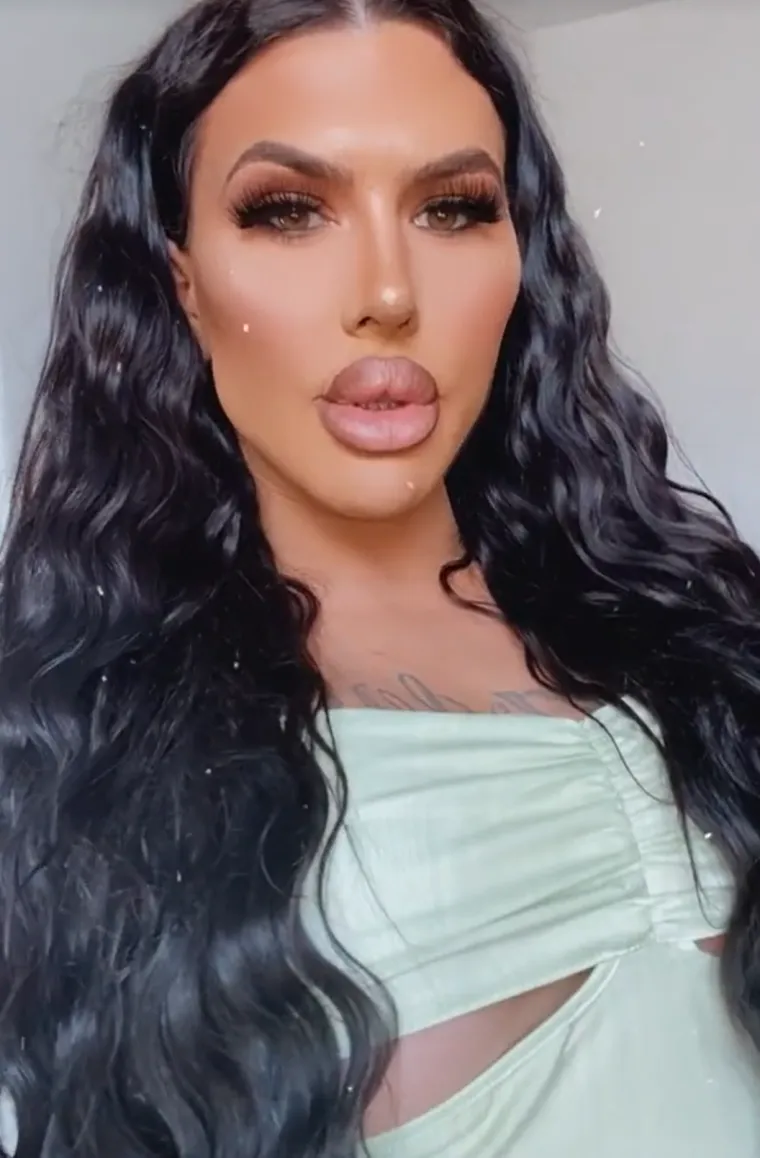 Godinama je punila obraze filerima, a sada je odlučila vratiti prirodno lice: Promjena je ogromna