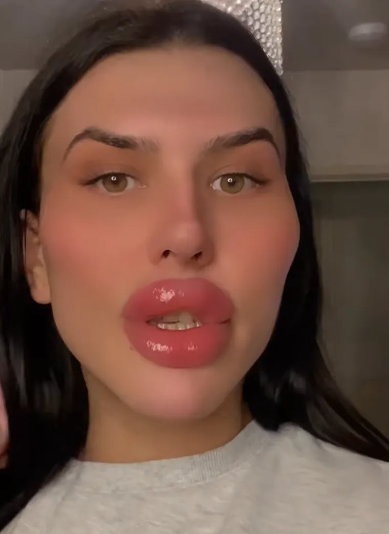 Godinama je punila obraze filerima, a sada je odlučila vratiti prirodno lice: Promjena je ogromna