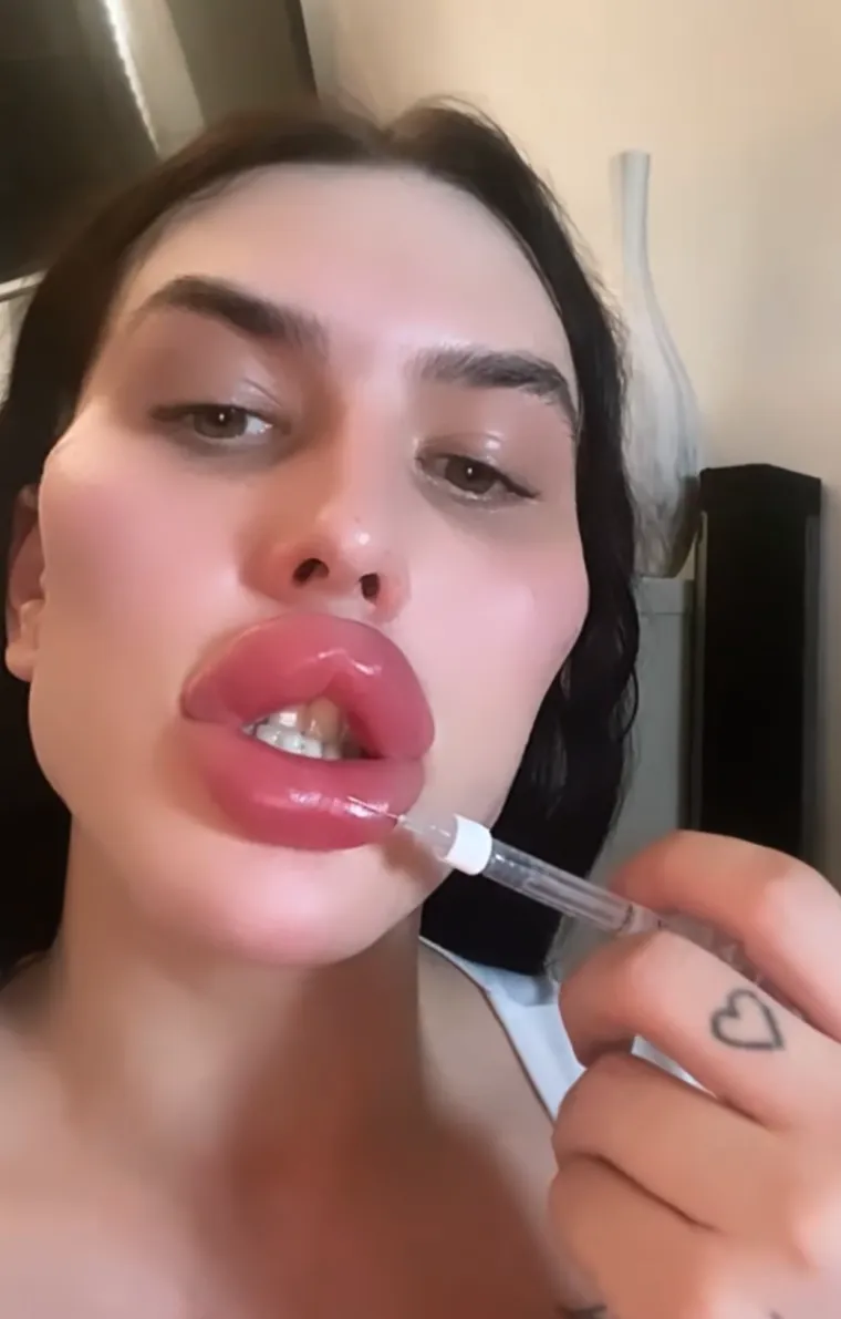 Godinama je punila obraze filerima, a sada je odlučila vratiti prirodno lice: Promjena je ogromna